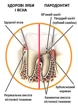 parodontit